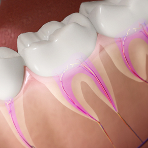 5 Benefits of the Root Canal Treatment
