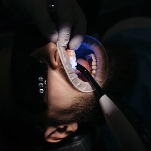 Can You Do Teeth Whitening After Root Canal?