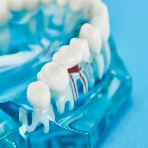 Close-up dental treatment model for root canal in Niles