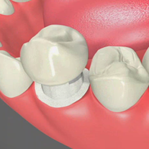 Ceramic Crowns