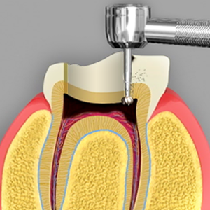 Pulpotomy