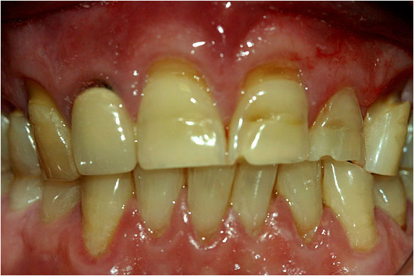 Dental Crowns Before