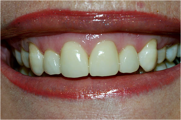 Veneers After